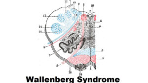 Wallenberg Syndrome
