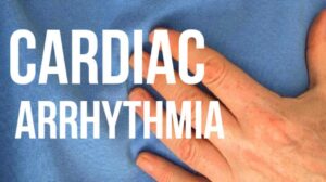 Cardiac Arrhythmia: 5 Types, Risk Factors, Causes, Symptoms, and Treatment