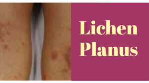 Lichen Planus: 4 Symptoms, and Causes