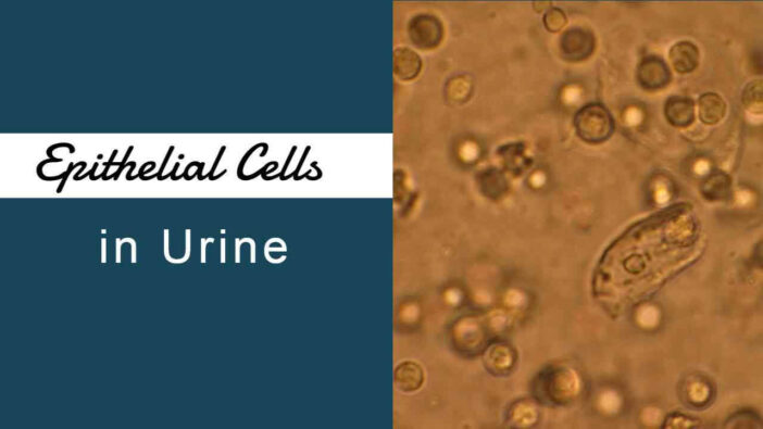 Epithelial Cells in Urine