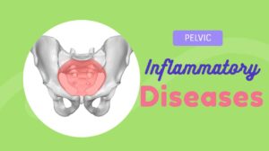Pelvic Inflammatory Disease: Causes, Symptoms, Diagnosis, Treatment, Prevention, and Complications