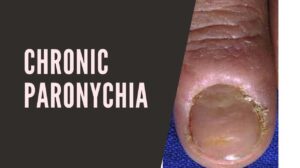 Chronic Paronychia: Causes, Symptoms, Treatment, and Prevention