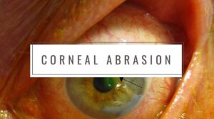 Corneal Abrasion