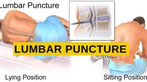 Lumbar Puncture: Indication, Precautions, Preparation, Procedure, Side Effects, and Recovery