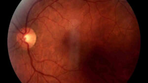 Retinal Detachment: Causes, Symptoms and Treatment [Full Explanation]