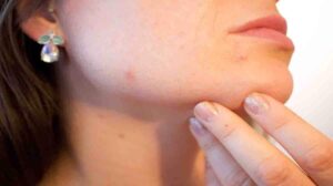 How To Get Rid of Pimples on The Face Naturally