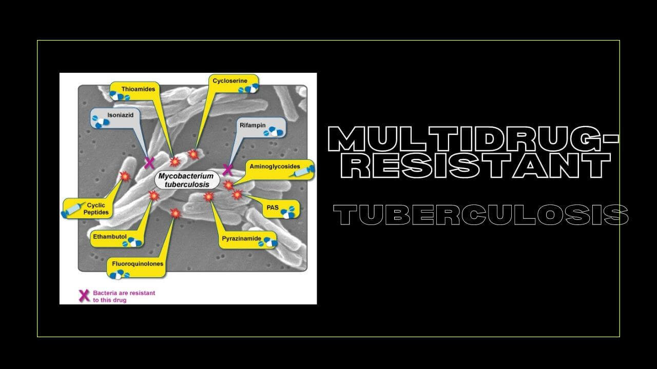 MultidrugResistant Tuberculosis Causes, Symptoms, How To Control It
