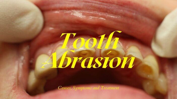 Tooth Abrasion