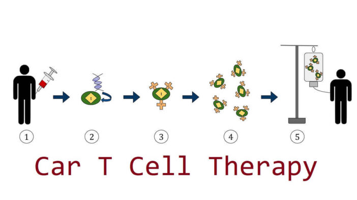 Car T Cell Therapy