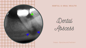 Dental Abscess: Causes – Symptoms and Treatment [Full Explanation]
