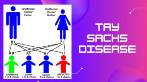 Tay Sachs Disease