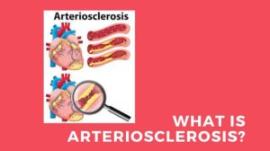 What Is Arteriosclerosis – Signs, Causes, Symptoms, and How to Treat