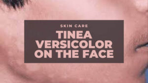 Tinea Versicolor On The Face: Causes, Symptoms and Effective Ways to Get Rid of It