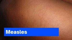 Measles: Symptoms, Treatment, and Prevention