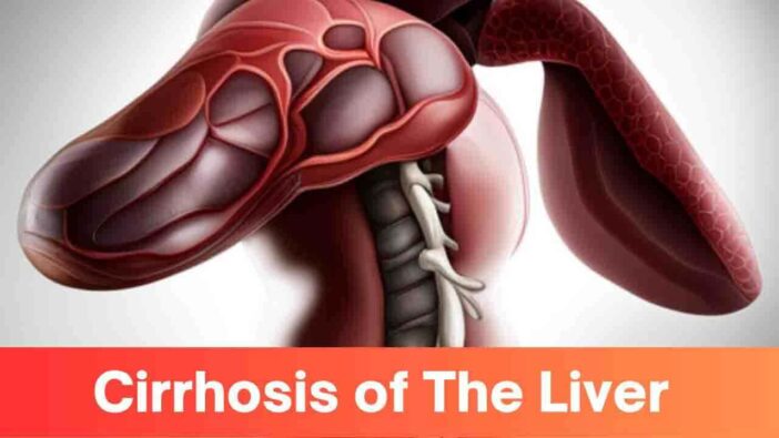 Cirrhosis of The Liver
